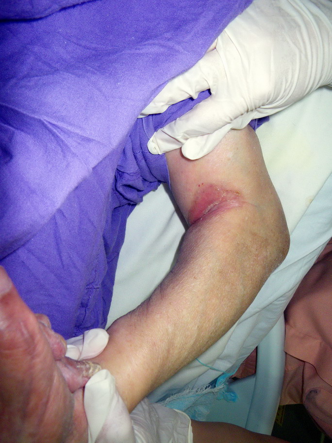 Elbow